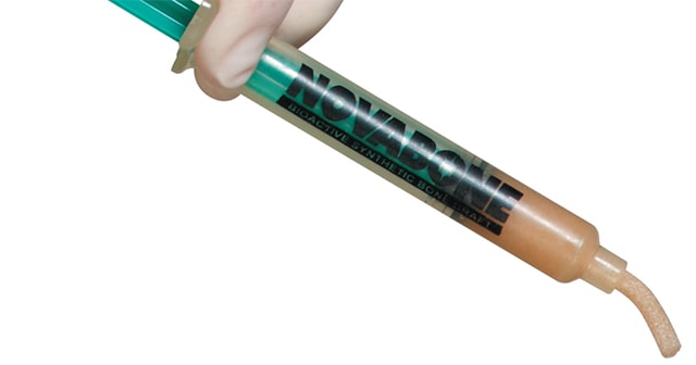  First Foot and Ankle Specific Bioglass Syringe Delivery System